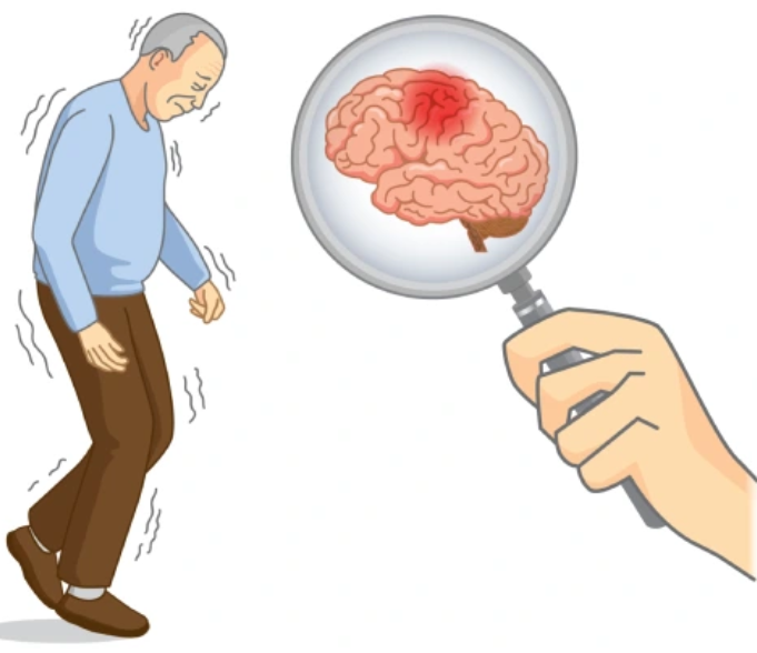 Parkinson Treatment in Mumbai
