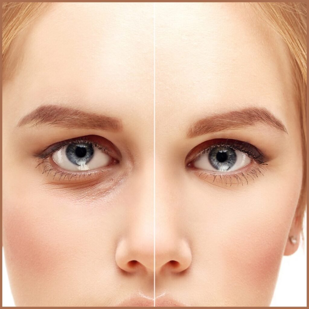 Eyelid surgery in Mumbai