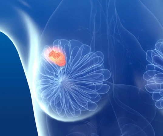 A Clinical Conversation on Fibroadenoma Surgery in Mumbai Doctor Near Me Fibroadenoma Surgery in Mumbai