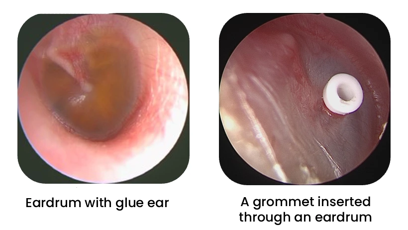 Grommet Insertion in Mumbai | ENT Insights by Dr Kovale Doctor Near Me Grommet Insertion in Mumbai
