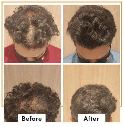 Hair loss treatment in South Mumbai