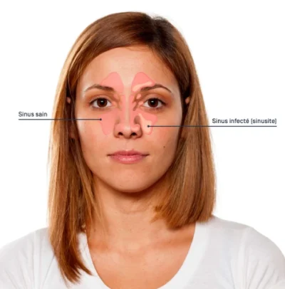 sinus specialist in mumbai