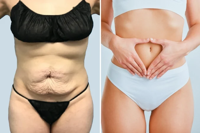 Tummy Tuck in Mumbai | Expert Insights by Dr Barve Doctor Near Me Tummy Tuck in Mumbai