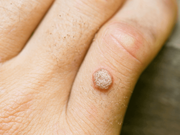 A Clinical Visit to Understand Wart Removal Treatment in Mumbai Doctor Near Me wart removal treatment