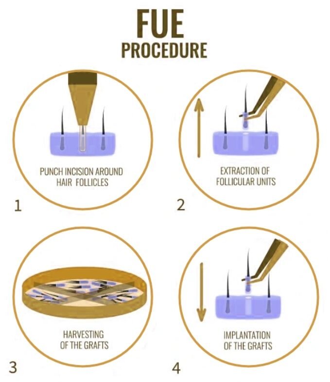 FUE Hair Transplant Mumbai FUE Hair Transplant Mumbai