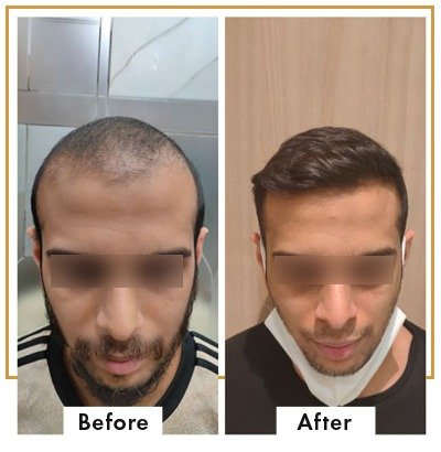 Hair transplant in South Mumbai