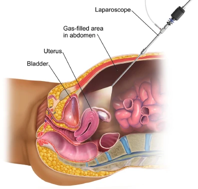 Laparoscopic Hysterectomy Mumbai