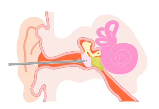 Best Myringotomy Doctor Mumbai