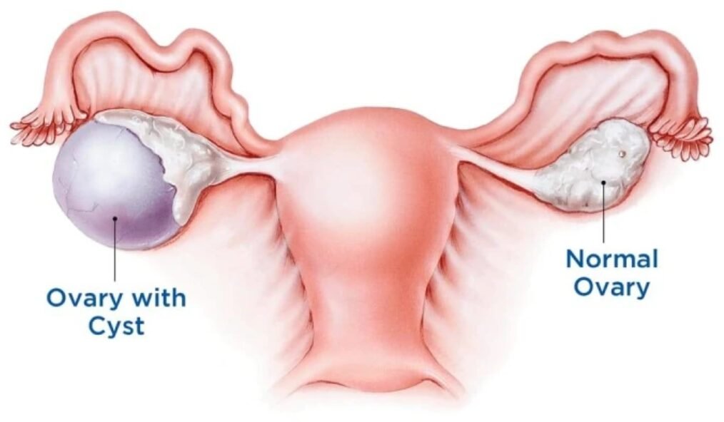 Ovarian cyst surgery in Mumbai