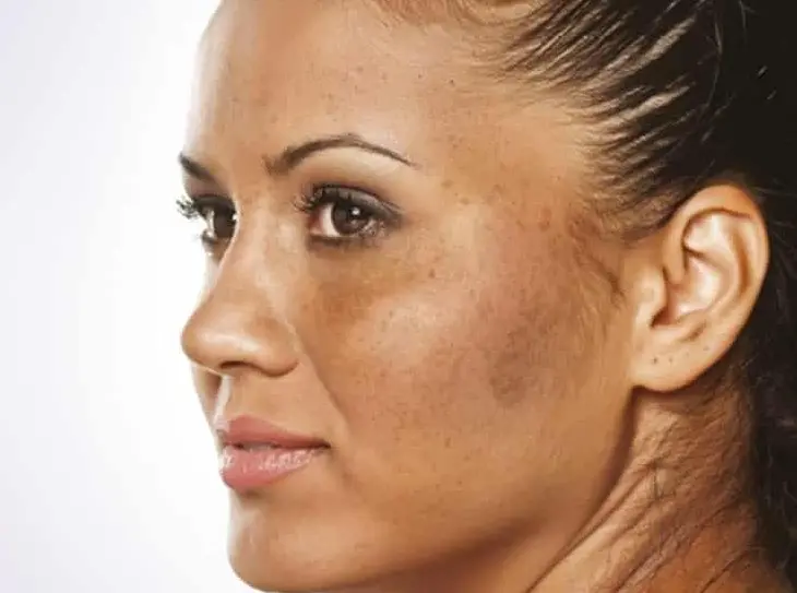 A Closer Look at Hyperpigmentation Treatment in Mumbai: My Visit to Ambrosia Aesthetics Doctor Near Me hyperpigmentation treatment in mumbai