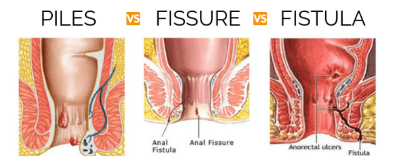 Fissure Specialist in Borivali
