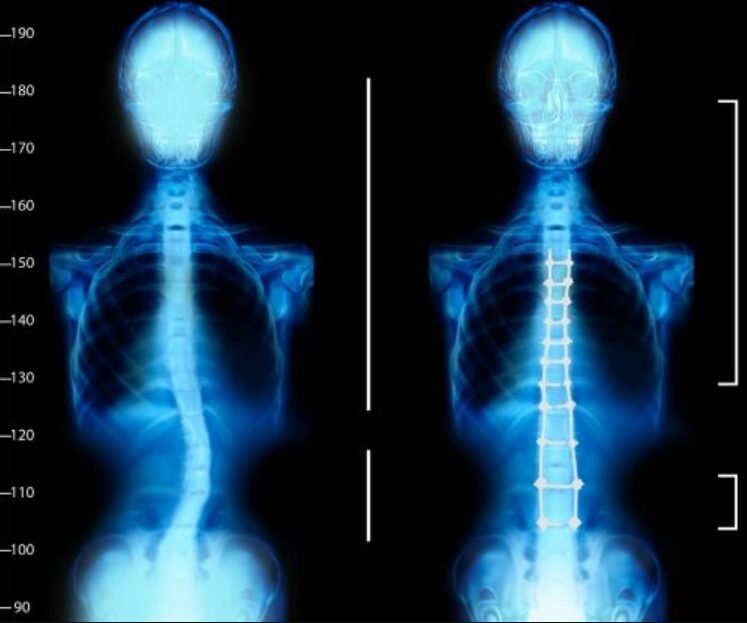 Scoliosis surgery in Mumbai