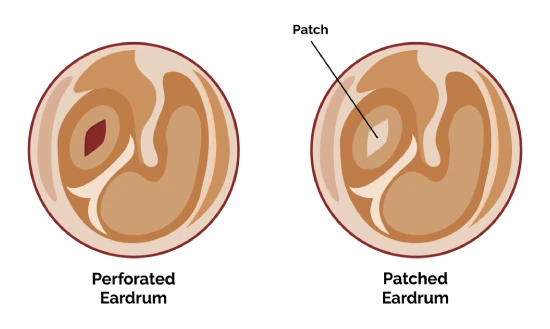 best tympanoplasty surgeon in mumbai
