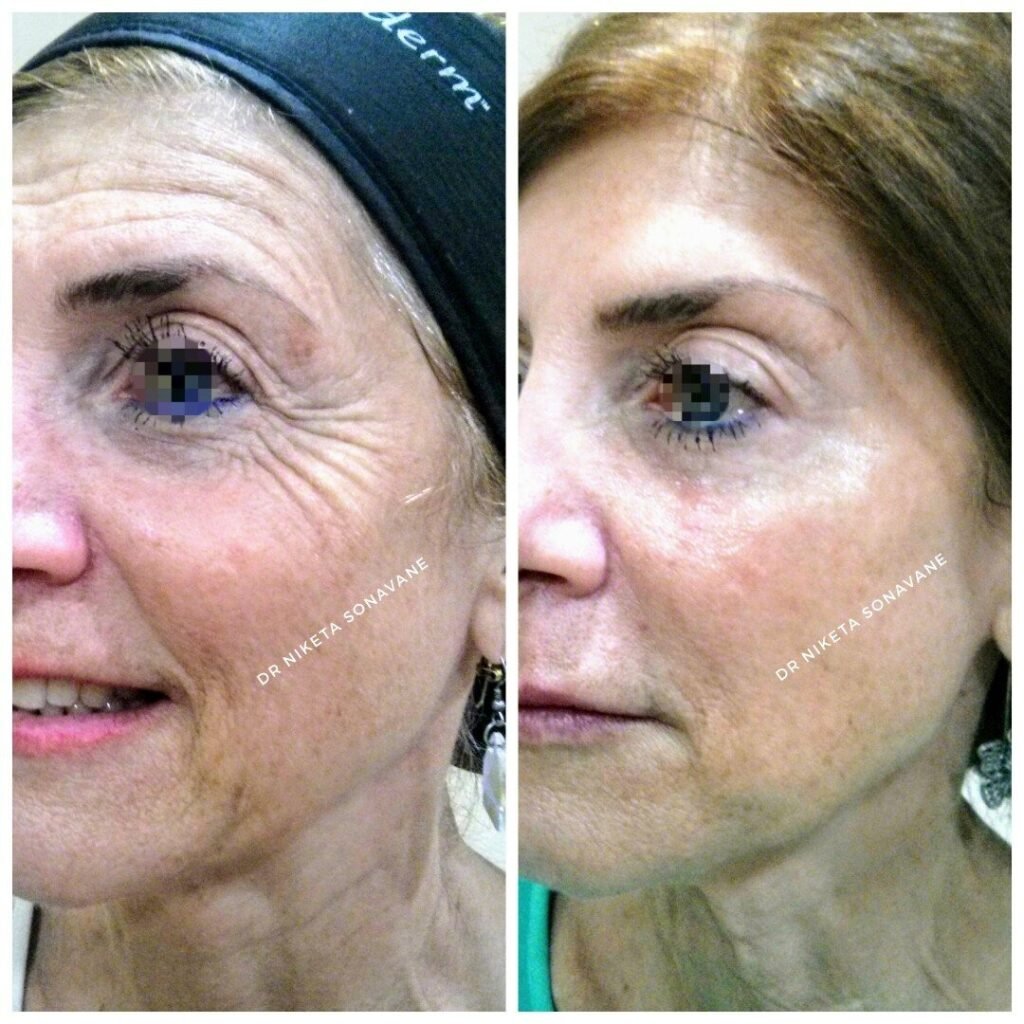 A Closer Look at Botox Treatment with Dr. Niketa Sonavane Doctor Near Me botox treatment in mumbai