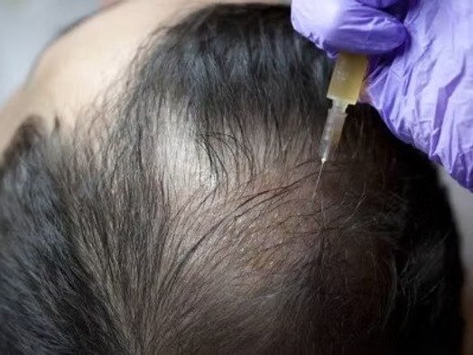 A Closer Look at Hair Loss Treatment in Mumbai with Dr. Niketa Sonavane Doctor Near Me hair loss treatment in mumbai