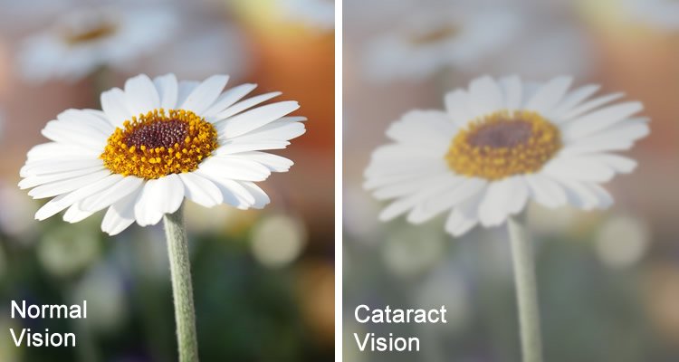 Cataract Surgery Cost in Mumbai