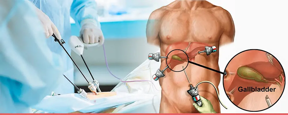 laparoscopic cholecystectomy mumbai