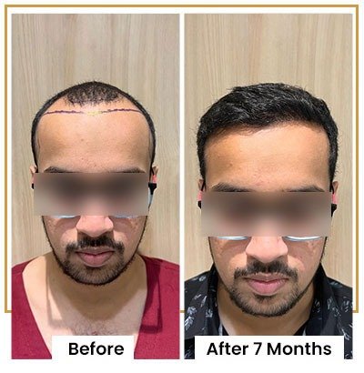 High Density Hair Transplant Mumbai