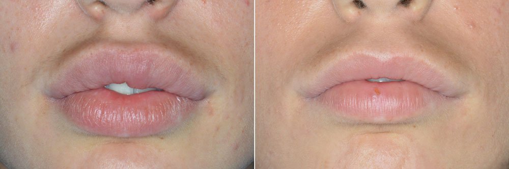 best lip reduction surgery in mumbai