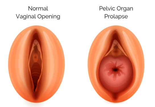 Pelvic Organ Prolapse Surgery Mumbai