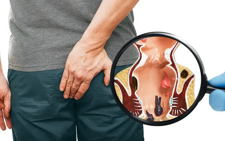 hemorrhoids treatment in mumbai