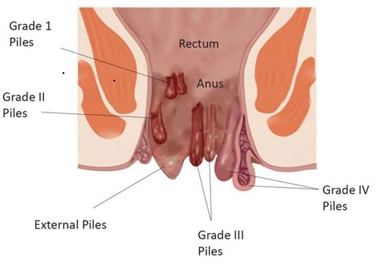 Piles Treatment Mumbai