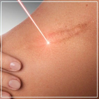 scar removal surgery in mumbai