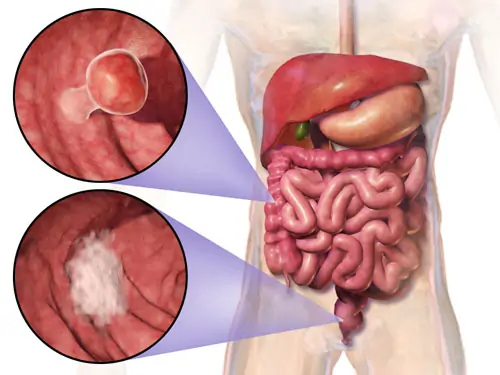 rectal cancer treatment mumbai